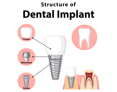 Dental Implants Dayton, Ohio